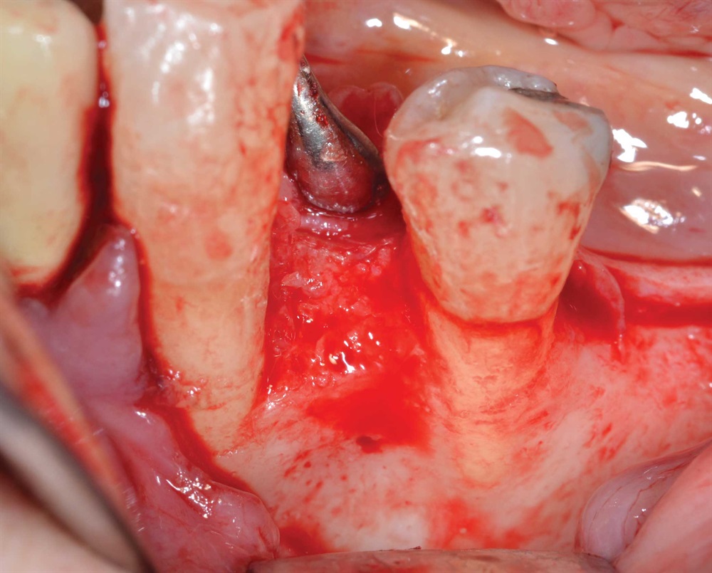 Tarquini_Periodontal intrabony defect